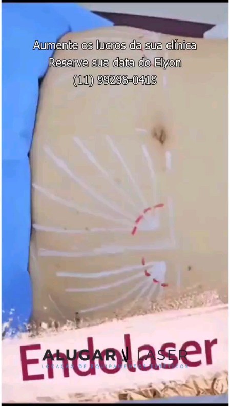 Imagem do Instagram relacionada ao post: Aumente os lucros da sua clínica com o Endolaser Elyon