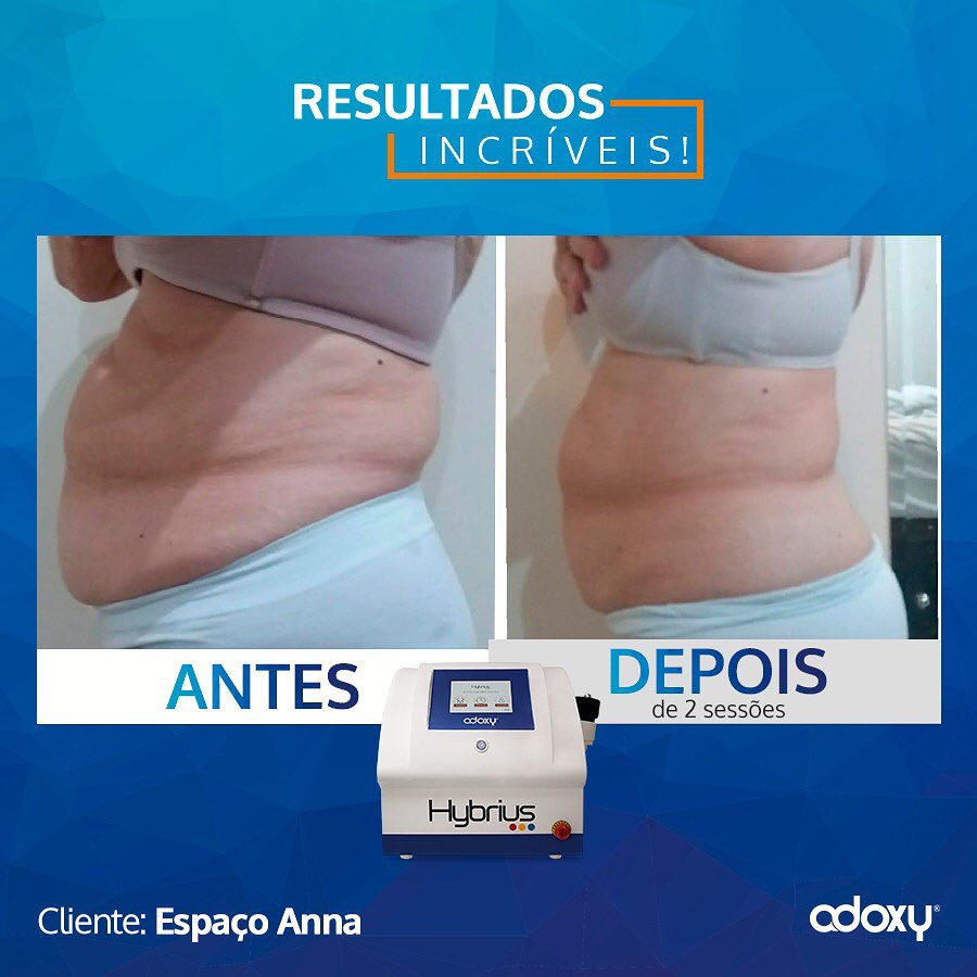 Imagem do Instagram relacionada ao post: Resultados Incríveis com Laser Hybrius: Alugue Agora!