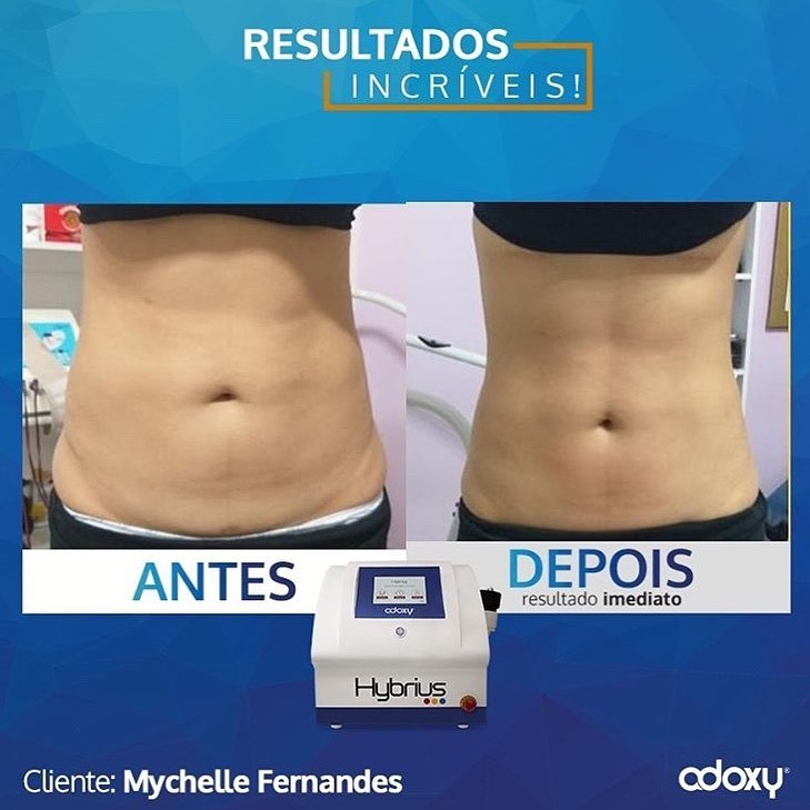 Imagem do Instagram relacionada ao post: Resultado Incrível com Hybrius: Depilação a Laser