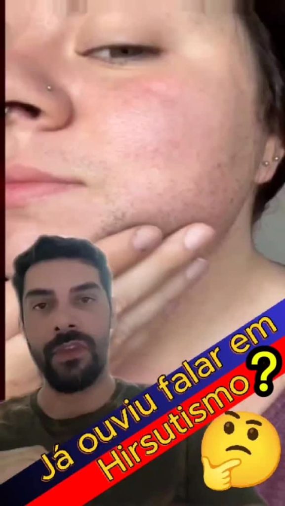 Imagem do Instagram relacionada ao post: Hirsutismo: Como a locação de laser pode transformar sua clínica