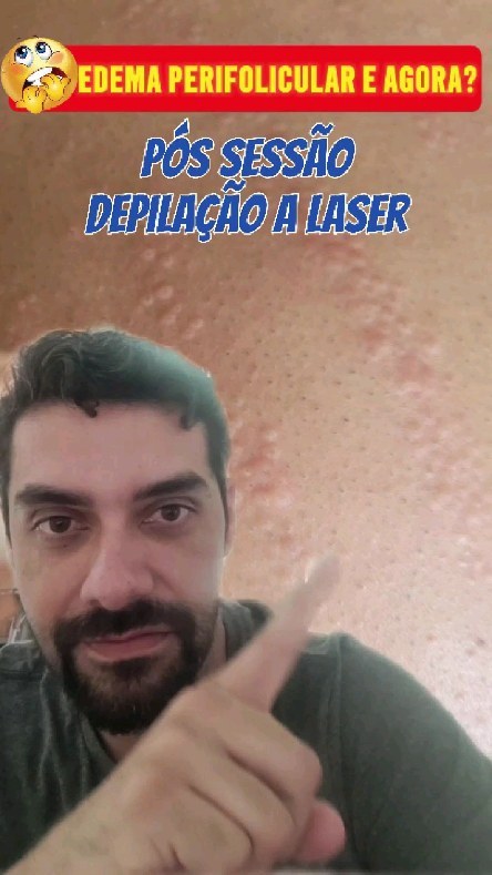 Imagem do Instagram relacionada ao post: Edema Perifolicular: Sinal de Resultado ou Motivo de Susto?